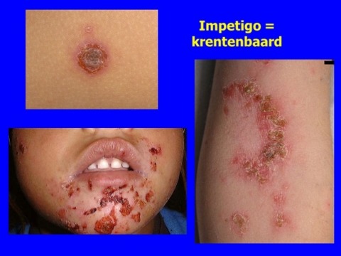 Krentenbaard bij kinderen